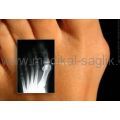 GECE-ATELİ-HALLUX-VALGUS-ATELİ